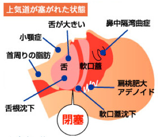 気道が塞がれた状態