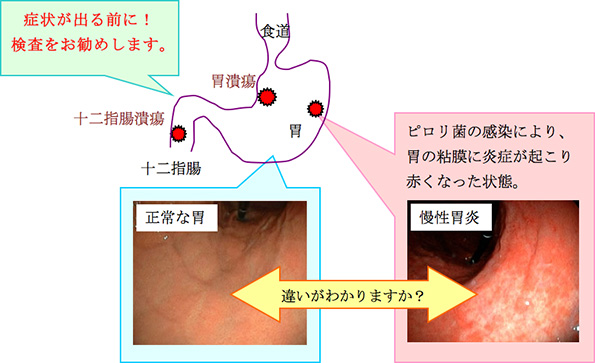 症状が出る前に！検査をお勧めします。